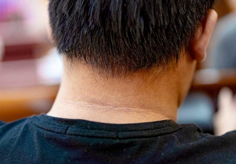 Acanthosis Nigricans: Treatment, Pictures, and Causes