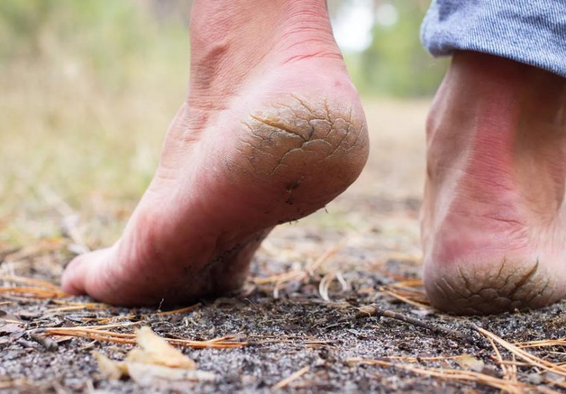 How To Heal Your Cracked Heels