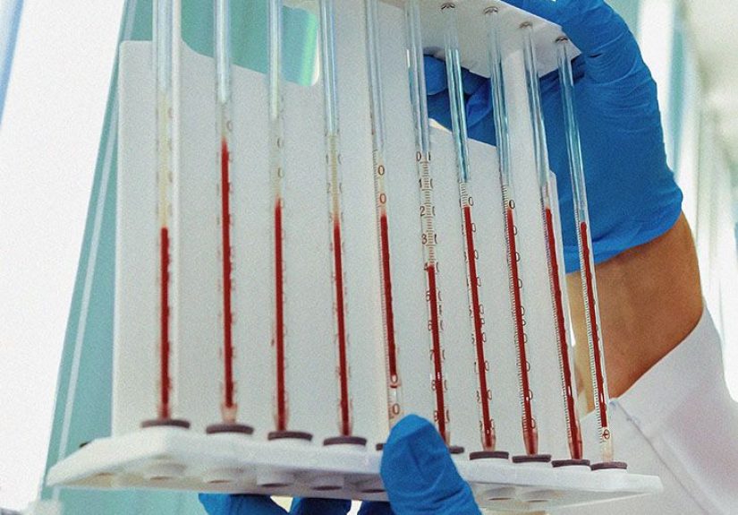 Multiple myeloma stages: Explanation, outlook, coping, and more