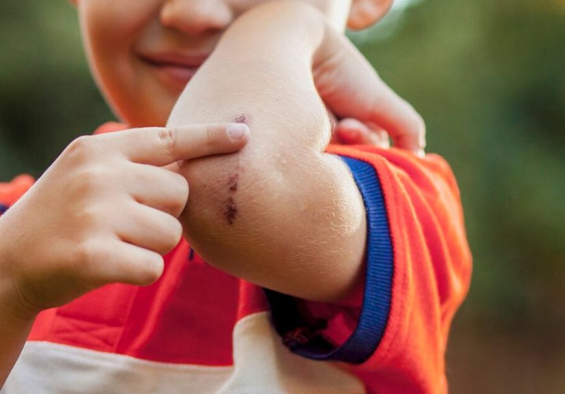 Picking Scabs: How to Stop Compulsive Picking and Heal Scars