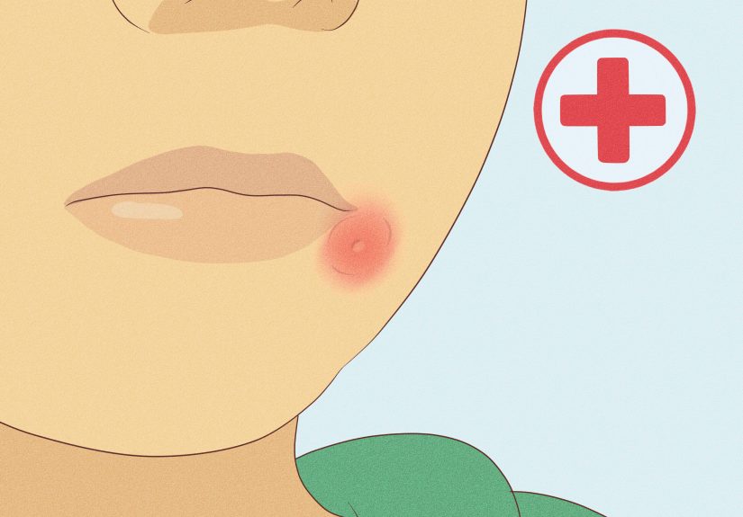 5 Ways to Treat a Wasp Sting on a Child