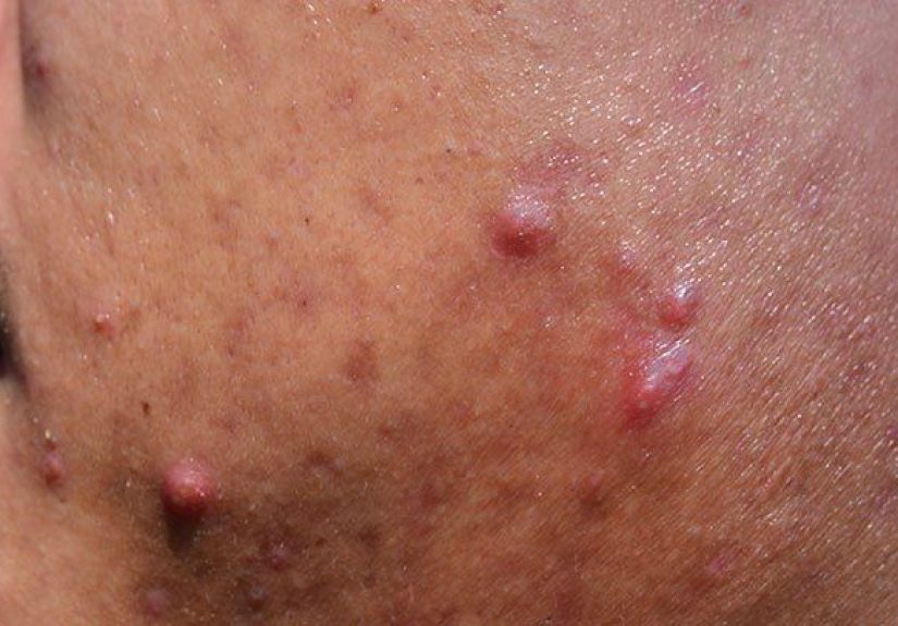Acne Types and Symptoms