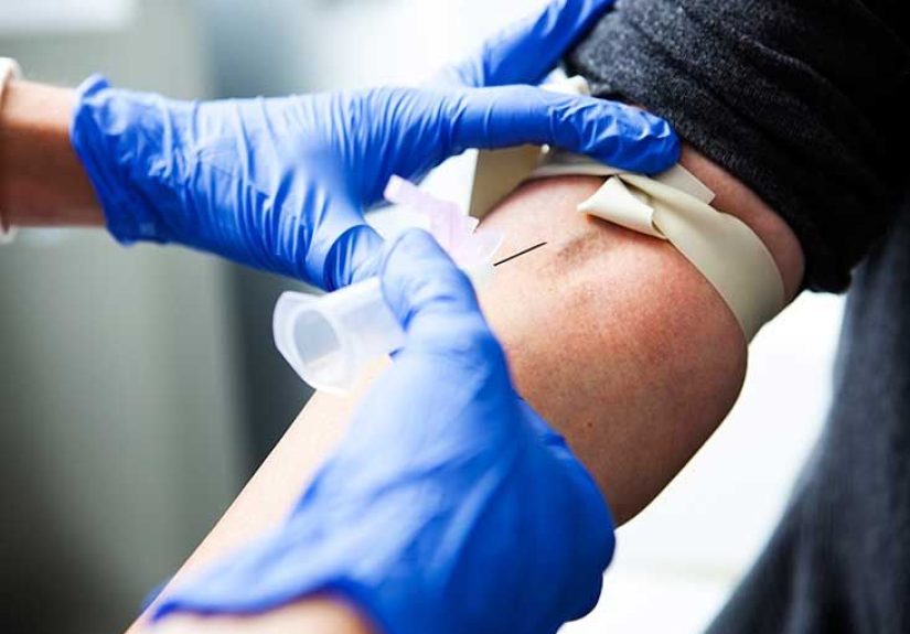 Aldosterone Test: Procedure, Uses, and Results