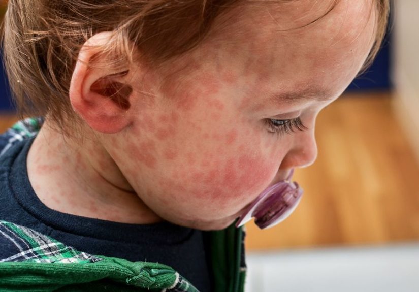 Baby Allergic Reaction to Food: Signs and Symptoms