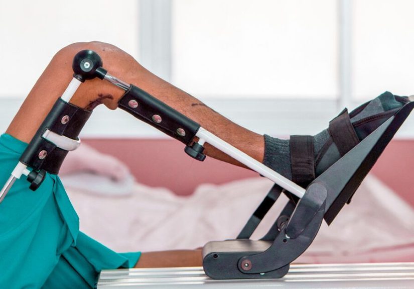 CPM Machine Uses, Benefits, Costs, and Precautions Following Surgery