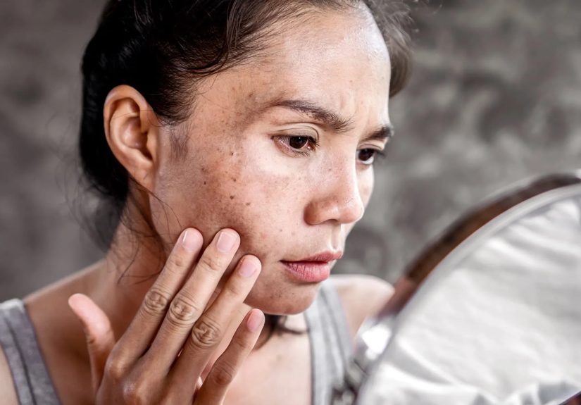 How Do You Get Rid of Age Spots?