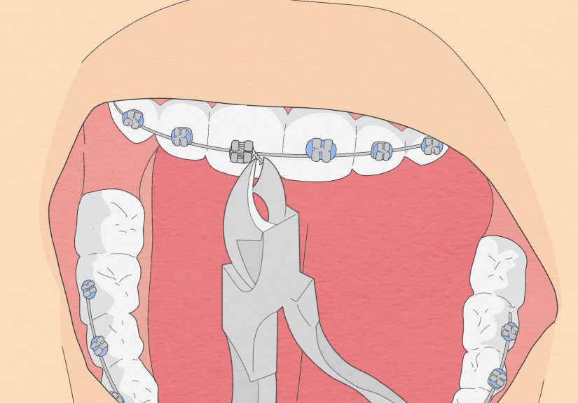 How to Fix a Broken Braces Wire: 6 Simple Ways
