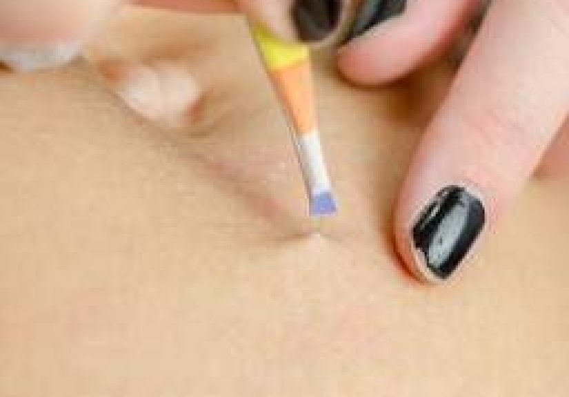 Ingrown Hair: Treatment and Prevention