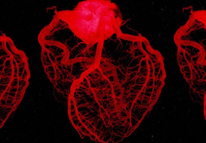 Mobitz type II heart block: Causes, symptoms, and treatment