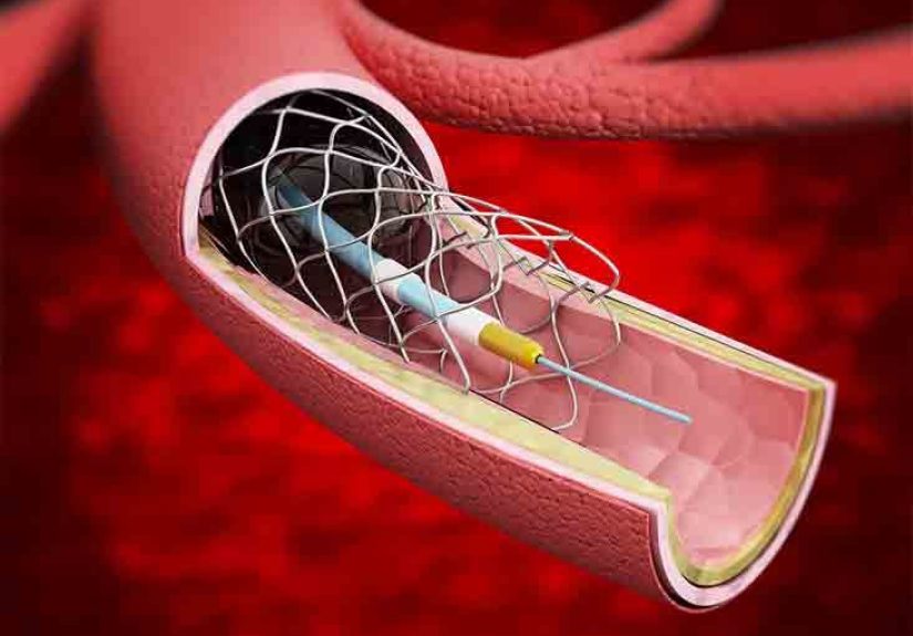 Stent: Purpose, Procedure, and Risks
