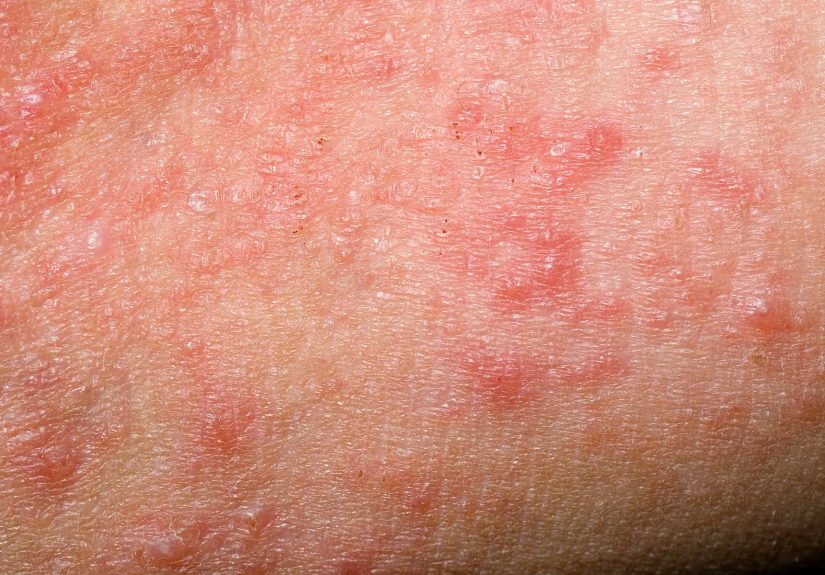 Understanding and Managing Scaly Skin: Causes, Symptoms, and Treatments