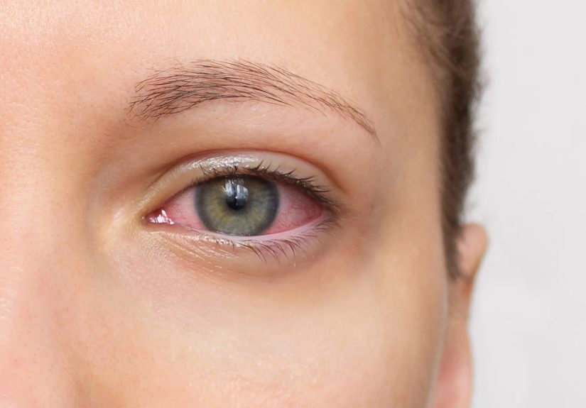 Uveitis Symptoms: Identifying Serious Underlying Conditions