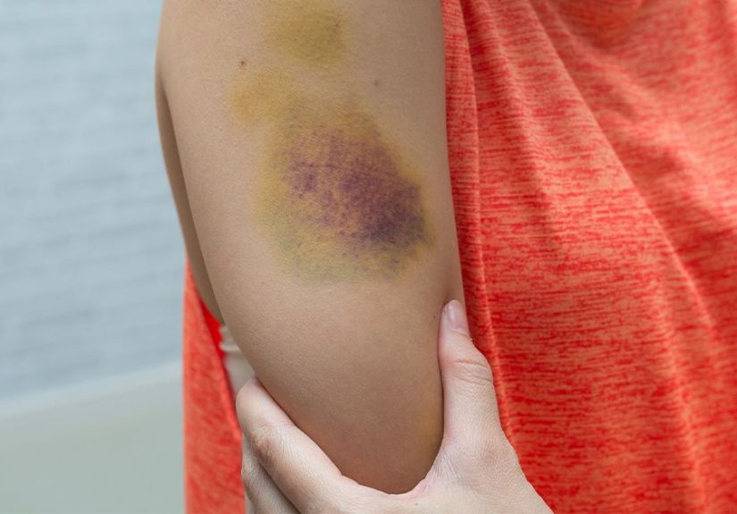 Bruise Itch Causes, Risk Factors, and Treatment
