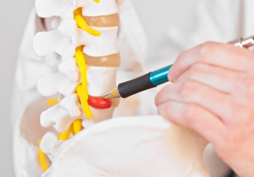 Herniated Disc Surgery: What to Expect