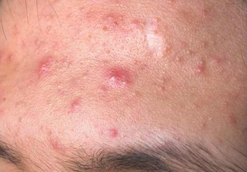 How Do Pimples Form? Causes, Types, and More
