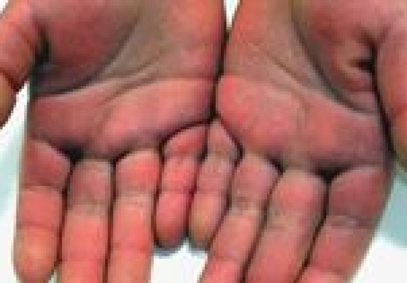 Kawasaki Disease: Causes, Symptoms & Diagnosis