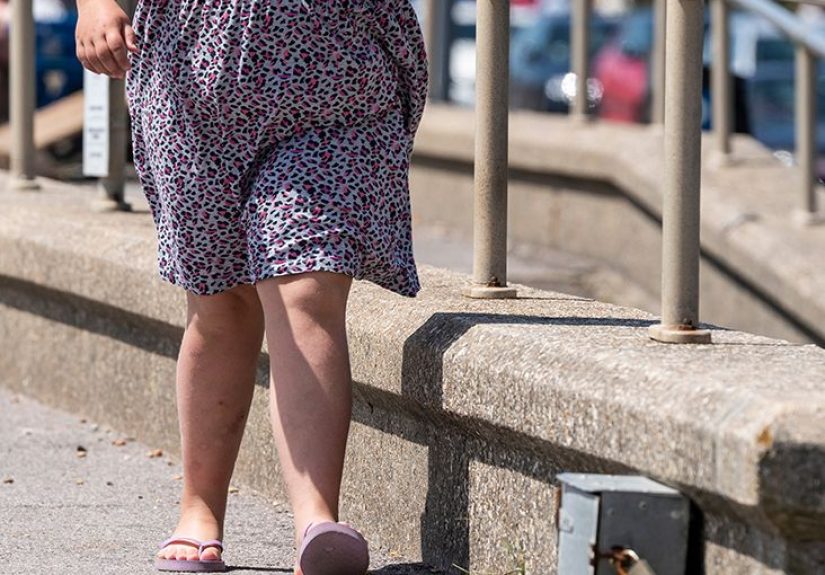 Knock-knees (genu valgum): Treatment, causes, and exercises