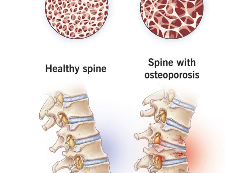 Osteoporosis: Symptoms, Causes & Treatment