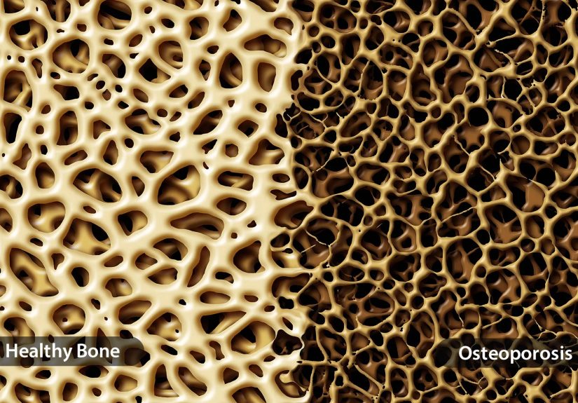 Osteoporosis Treatments: Medications, Home Remedies, Lifestyle, and More