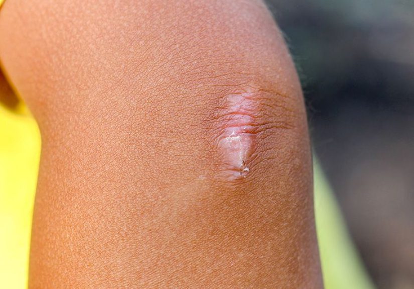 Scar tissue pain: What it feels like, why it happens, and treatment