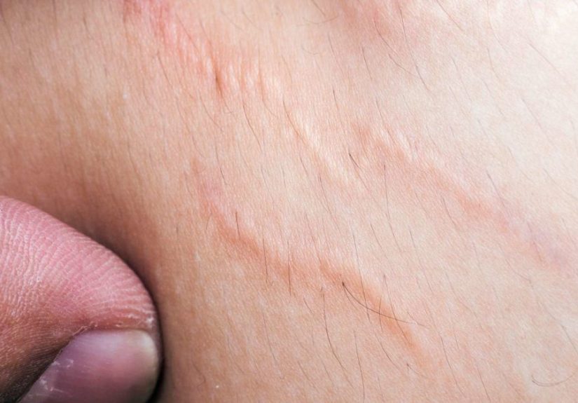 Stretch marks on thighs: Appearance, causes, and treatments