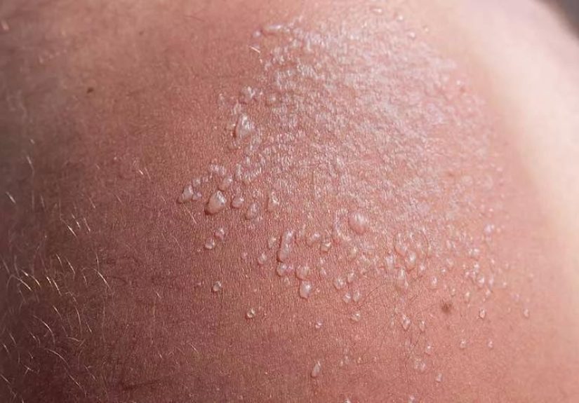 When To See a Doctor for a Sunburn