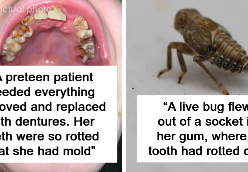 “Wouldn’t Drink Anything Except Coke”: 37 Dentists Reveal The Worst Oral Health Situations They’ve Encountered