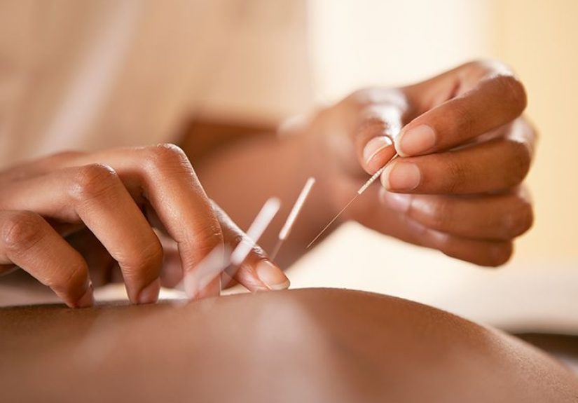Acupuncture After a Stroke: Does It Work?