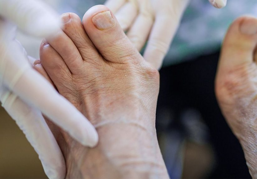 Gout: Symptoms, Causes, and Treatment