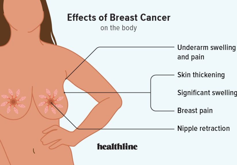 How Breast Cancer Affects the Body