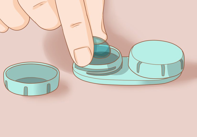 How to Insert and Remove a Scleral Lens: 12 Steps