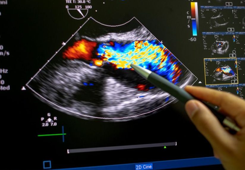Medicare and Echocardiograms: Cover, Costs, and More
