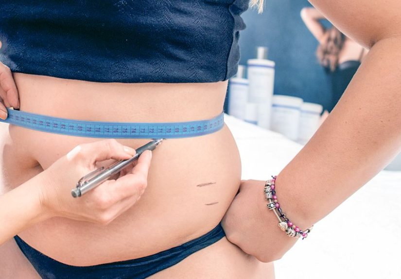 Panniculectomy vs. Tummy Tuck: What to Expect, Recovery, Costs