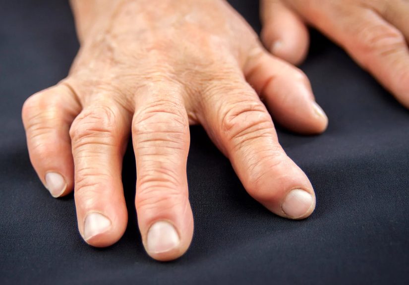 Rheumatoid Arthritis Deformities: Types and Medications