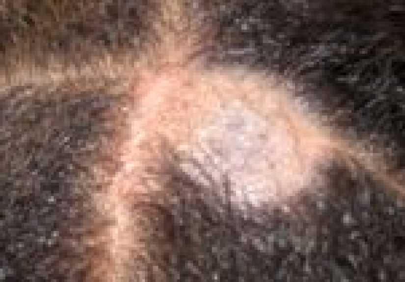 Ringworm of the Scalp (Tinea Capitis): Causes, Symptoms, and Treatment