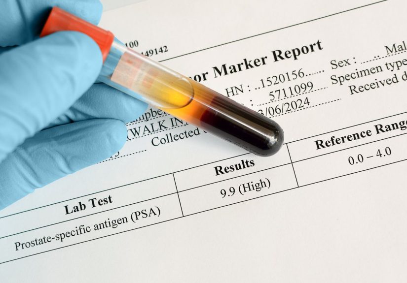 Why Is My PSA Level Going Up After Prostate Cancer Treatment?
